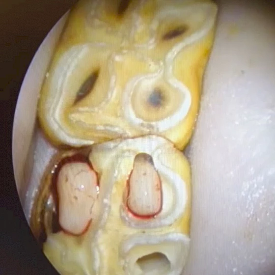 🦷Zahnerhaltungsbehandlung / Wurzelbehandlung🦷